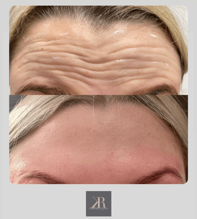 botox results
